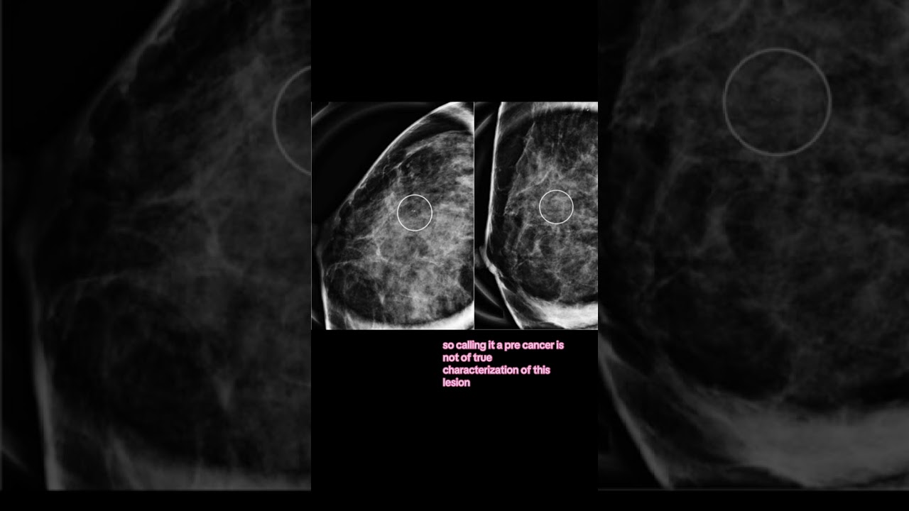 Busting breast cancer myths: all atypical ductal hyperplasia becomes cancer 
