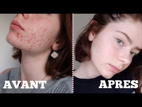Belanette acne