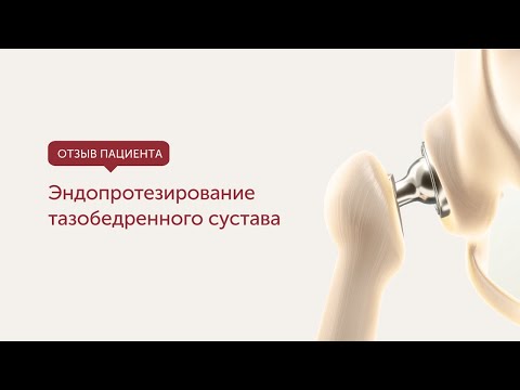 Эндопротезирование тазобедренного сустава. Отзыв пациента.