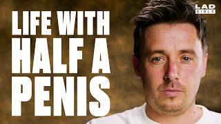 I Had Four Inches of My Penis Removed | Minutes With
