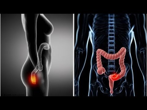 Video: Cirugía de Cuerpo Extraño