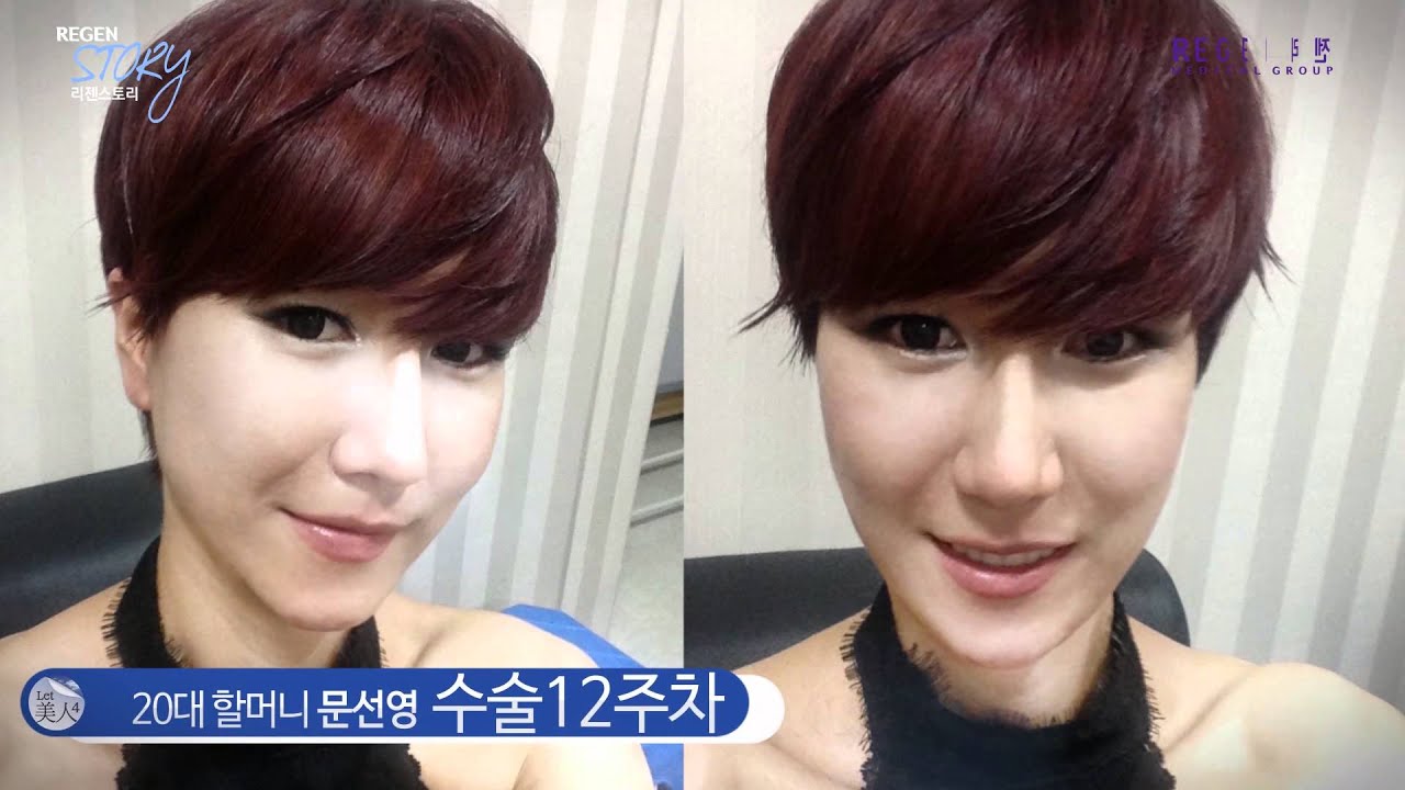 完全に別人 韓国の美容整形でレジェンド級の変貌を遂げた男 ロケットニュース24