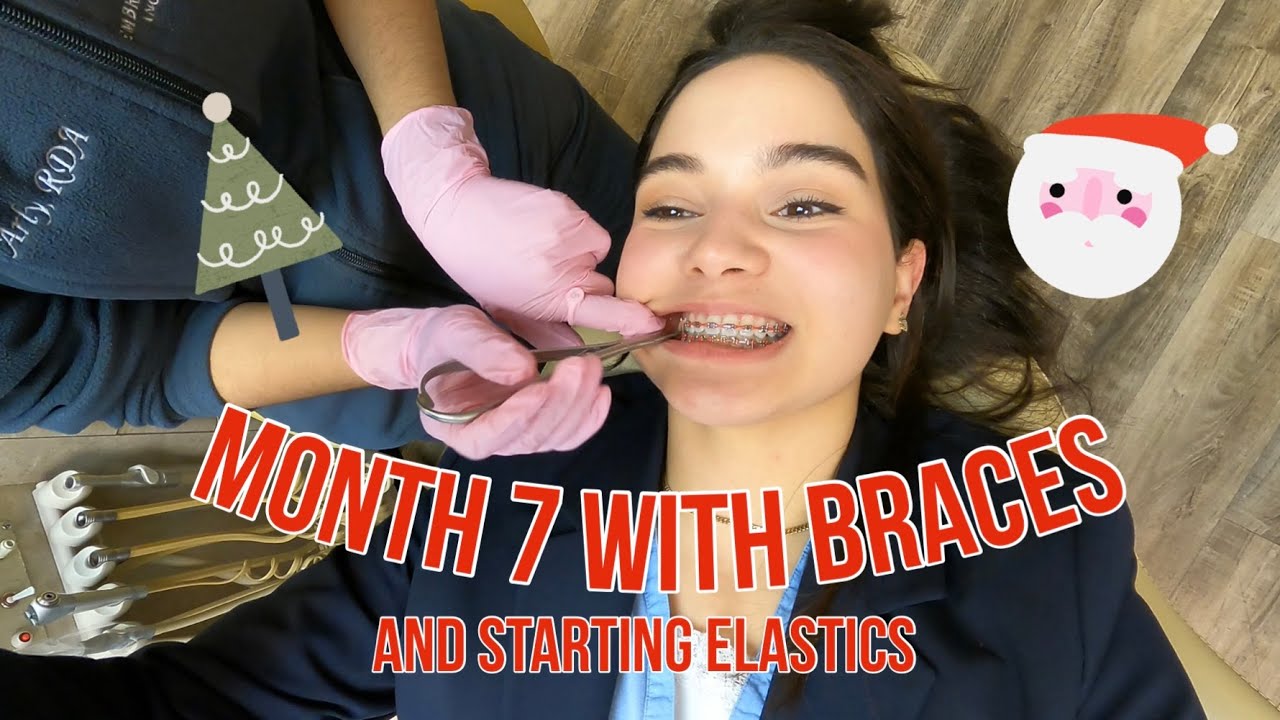 Braces Update 7 🦷 (Getting elastics on!)