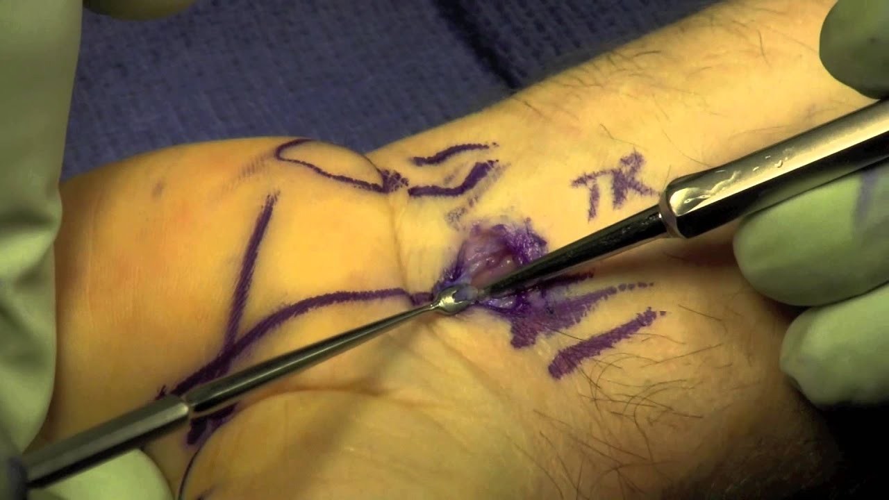 Endoscopic Carpal Tunnel Release YouTube