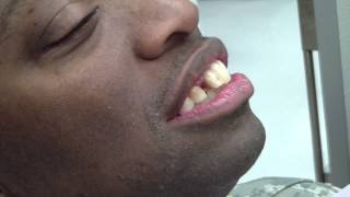 Immediate Denture - Interocclusal Record Verification - Raw Footage screenshot 2