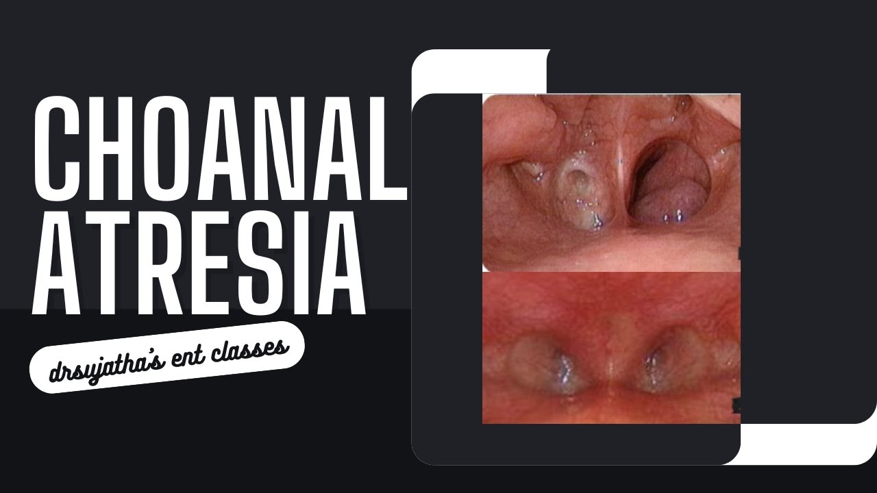 271. Атрезия хоан | Диагностика, типы и лечение для врачей-ординаторов ЛОР-врачей 