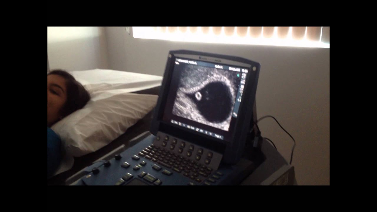 7 Weeks 6 Days Our First Ultrasound YouTube