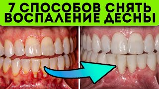 Десна кровоточили, не ел 3 суток, пока… простой народный рецепт от воспаления десен