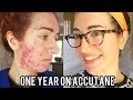 ACCUTANE: Before And After Severe Acne (With Pictures) My Experience | Jess Bunty