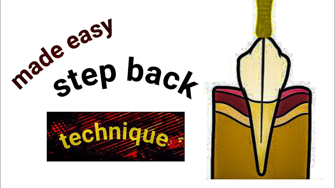 Master the Step-Back Technique in Endodontics: The Definitive Root ...