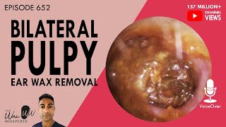 652 - Bilateral Pulpy Ear Wax Removal screenshot 5