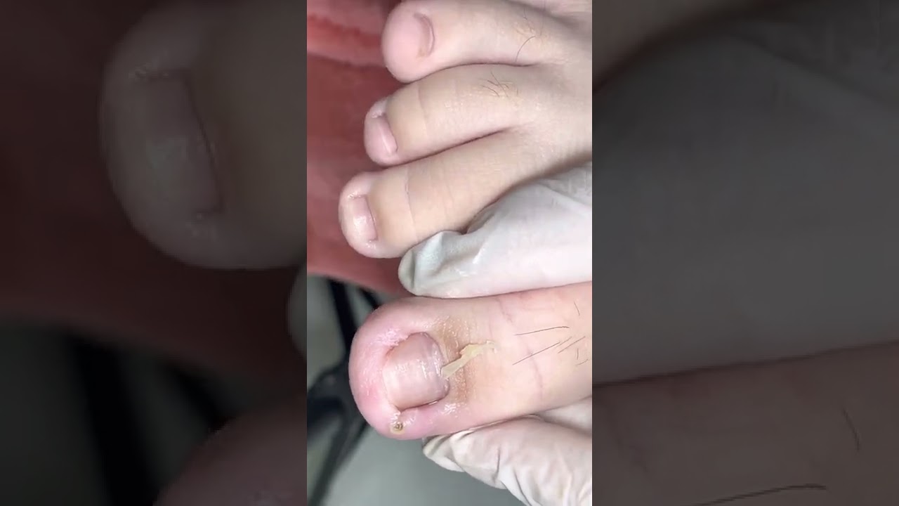 Ep_4107 Ingrown toenail removal 👣 ออกแล้ว..อุ้ย ยังมีอีก 😁 (clip from