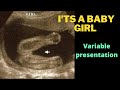 Its baby girl ultrasound at 18 weeks  variable presentation