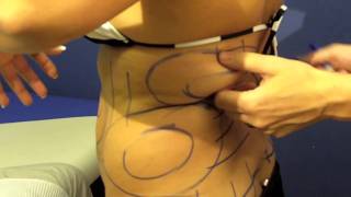San Diego Liposuction Testimonial Dr. Nowak