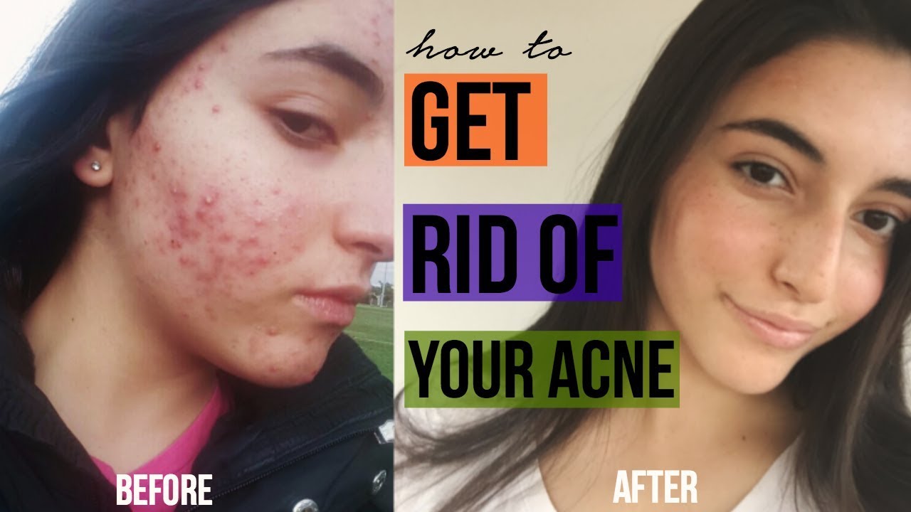 HOW I GOT RID OF MY ACNE FOREVER + skincare routine YouTube