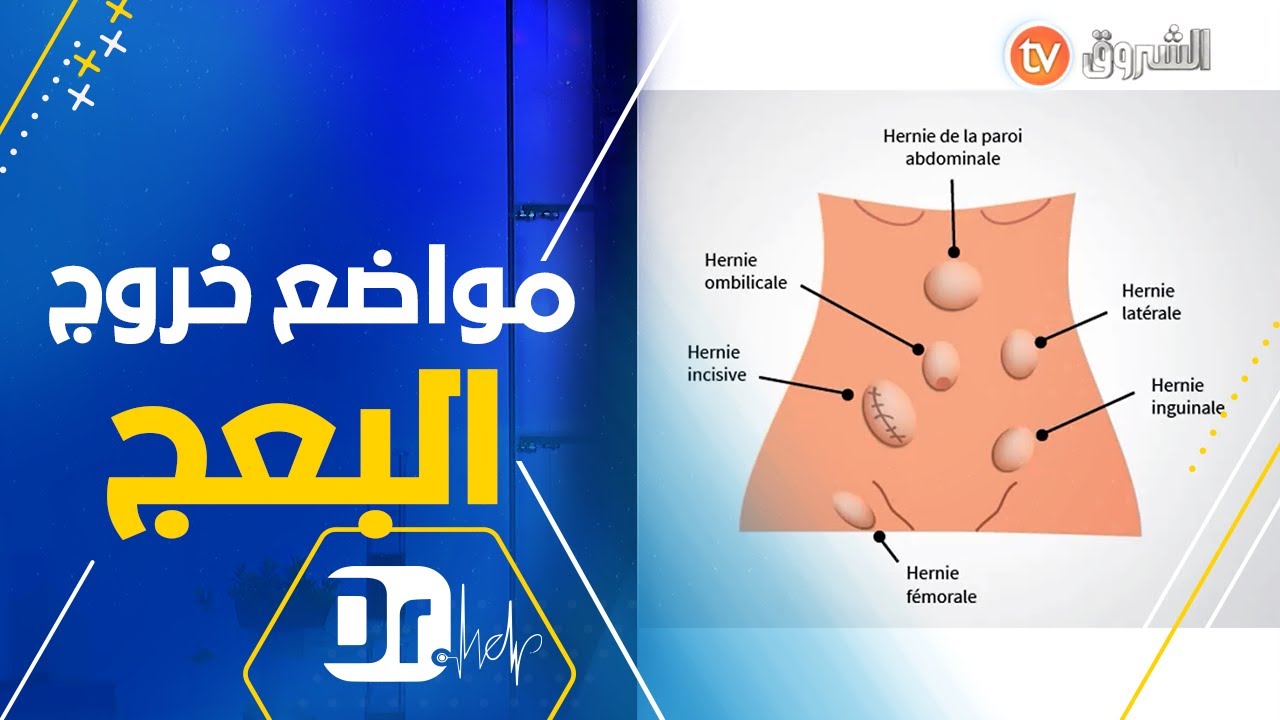 كيف حتى يظهر الفتق 