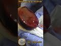 Gangguan Sirkulasi Jadi Pemicu Stroke? Ini Ikhtiar yang Dilakukan #bekam #stroke #hipertensi