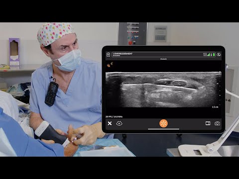 Image of WALANT for Carpal Tunnel Release