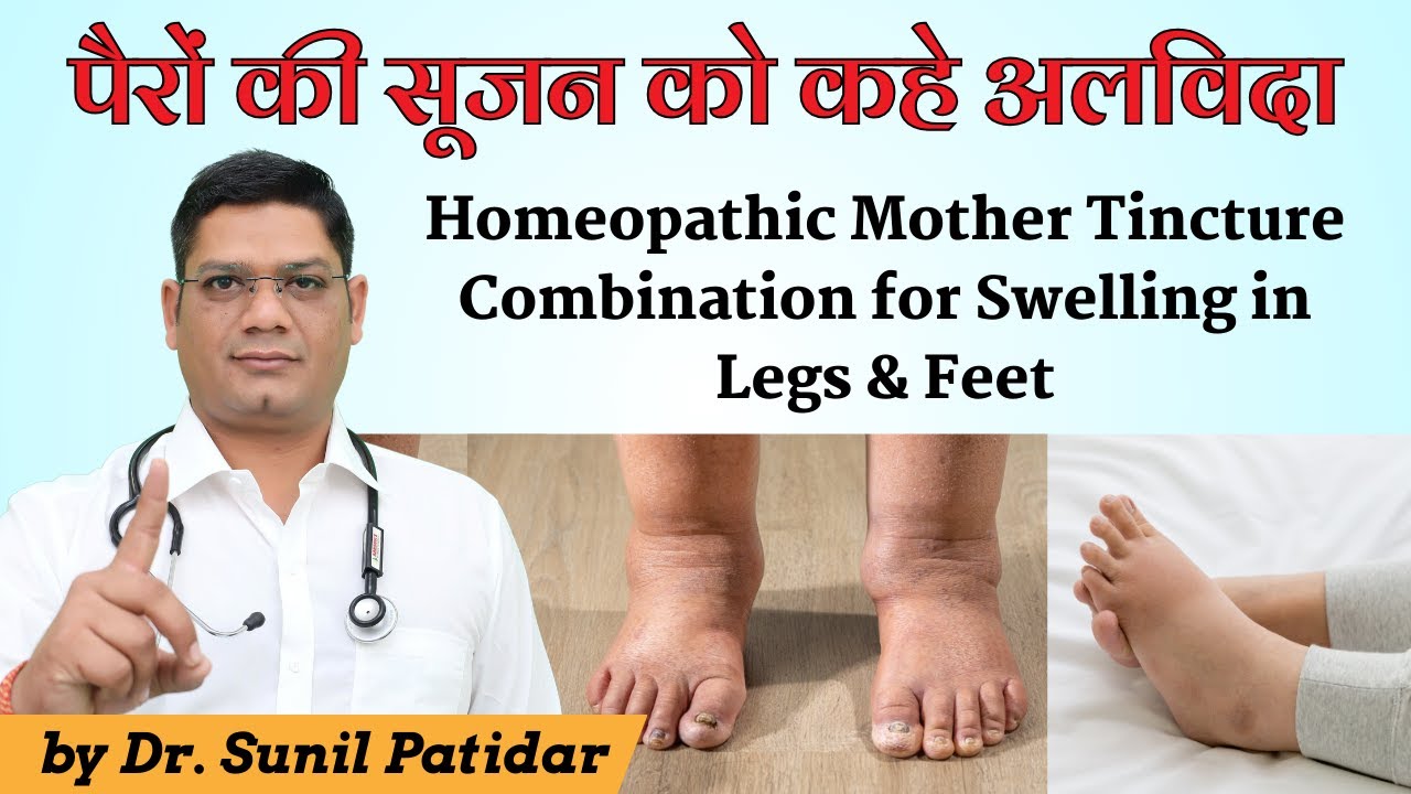 Homeopathic Mother Tincture Combination for Swelling in Legs & Feet | Dr Sunil Patidar 