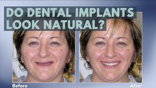 Do dental implants look natural? | No More Dentures! | All On 4, All On X | Hamilton, ON