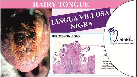Hairy tongue | Black hairy tongue | Developmental disturbances of tongue | Oral pathology #dentistry