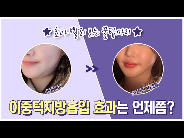 이중턱지방흡입효과 볼 수 있는 시기? (효과 빨리 보는 💙꿀팁💙까지!!)