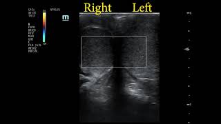 POCUS Case Testicular Torsion