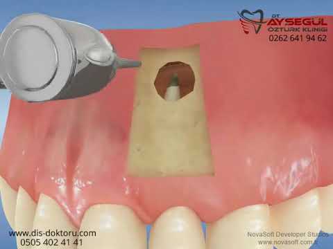Diş Kök Ucu Ameliyatı | Apikal rezeksiyon