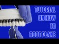 Dental Root Planing 101 - Step-by-Step
