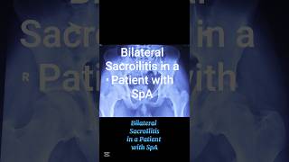 #bilateral sacroilitis #patient with spa