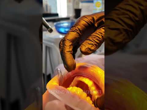 Video: Vad är Invisalign? | Osynlig tandreglering i Stockholm (Södermalm)