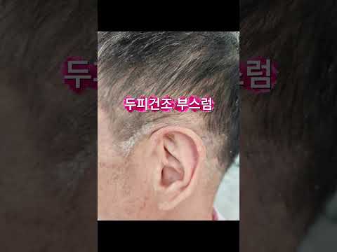 머리숱 고민 끝! 30년 경력 원장의 링거펌+두피디톡스 비법 대공개 | 역촌동 머리치장"