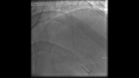 Microcatheter Tip Fracture During LAD CTO PCI: A Complication Video 8