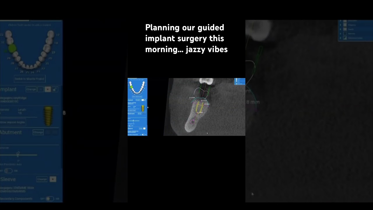 Planning a guided dental implant surgery 
