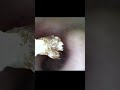 Ear Digging ends up with Huge Ear Wax with Hair!