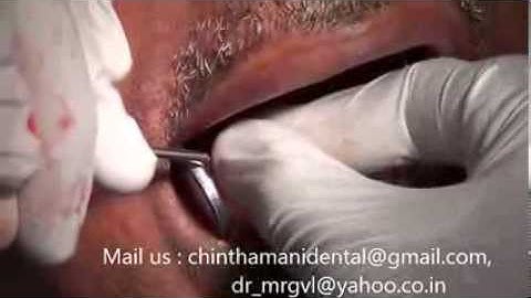Painless extraction of molar rootstumps and immediate implants in India  video part 2