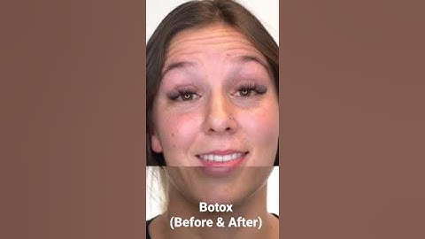 How I remove my wrinkles 😍👆#botox #shorts #results #wrinkles