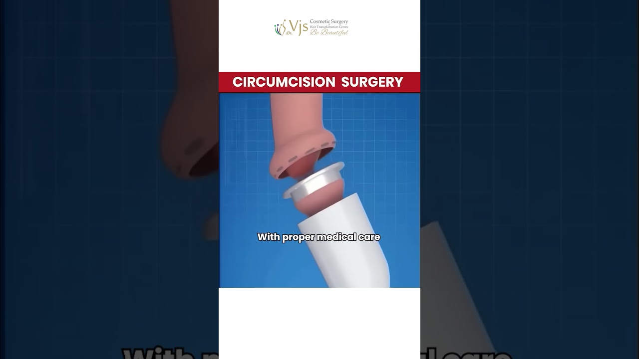 Circumcision: More Than a Ritual? | Circumcision Treatment Vizag | What Most Men Don’t Know