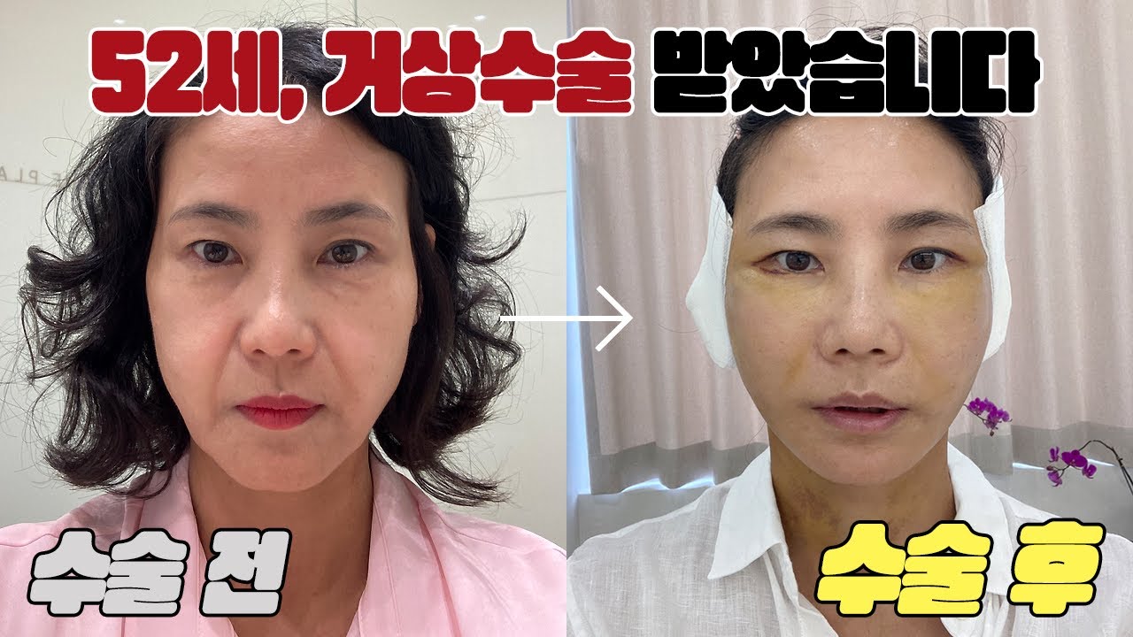 50대 안면거상 수술 후기!│수술 당일부터 7일차까지│얼굴주름 싹 없애는 방법