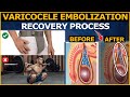 Varicocele treatment  your complete guide to varicocele embolization recovery process