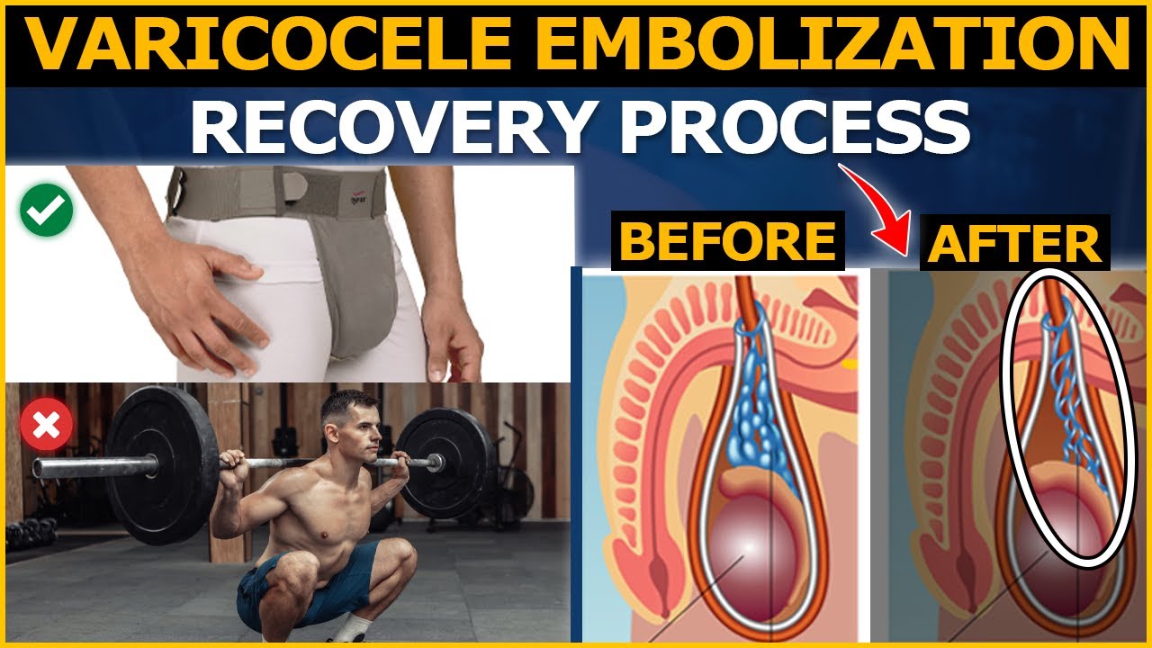 Varicocele Treatment : Your Complete Guide to Varicocele Embolization Recovery Process