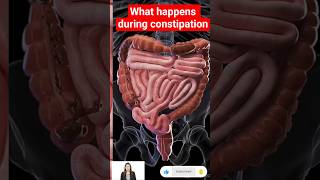 3D Animation: Constipation Explained | How the Gut Works & Why Stool Gets Stuck