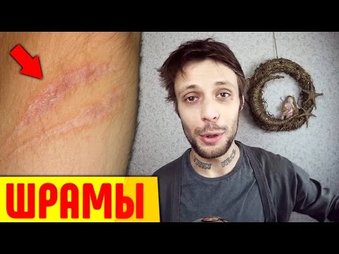 ПОКАЗЫВАЮ ЖУТКИЕ ШРАМЫ ПОКАЗЫВАЮ ЖУТКИЕ ШРАМЫ