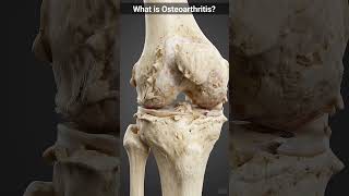⚡ Osteoarthritis? Don’t Let Joint Pain Slow You Down! ⚡