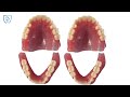 Digital Design 3D Printed Flexible Acrylic Denture Dental Lab