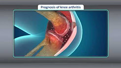 [Treatment] Treatment for Osteoarthritis of the Knee
