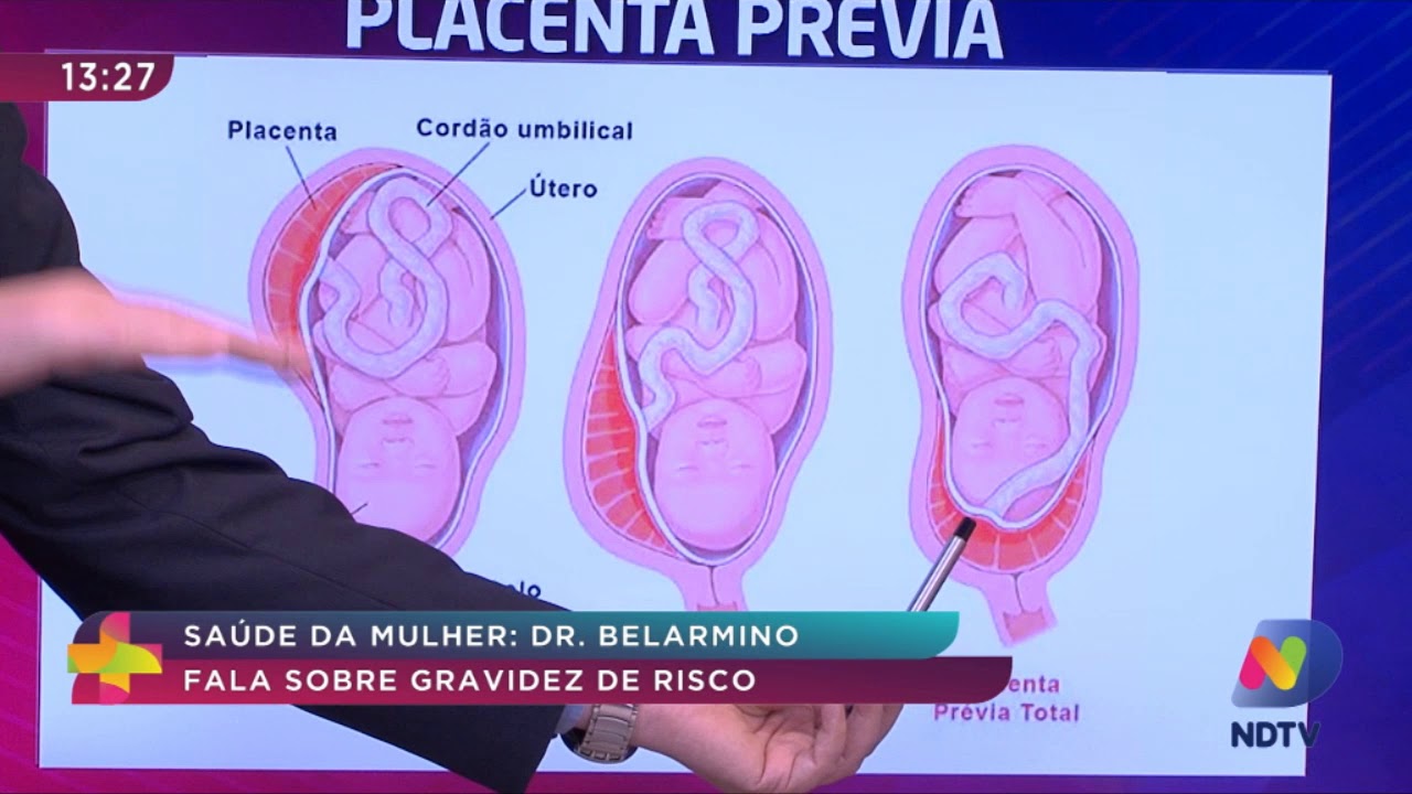 Saúde da Mulher: Dr. Belarmino fala sobre gravidez de risco Saúde da Mulher: Dr. Belarmino fala sobre gravidez de risco