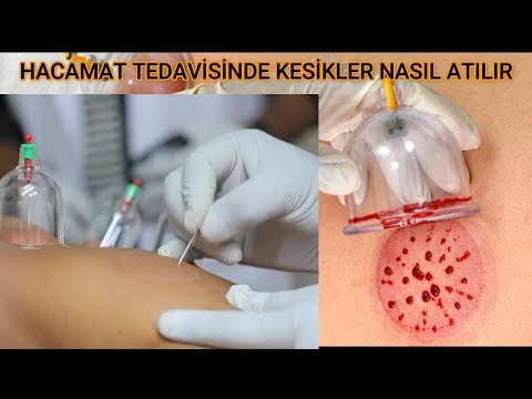 HACAMAT TEDAVİSİNDE  KESİK ATMA NASIL YAPILIR ?