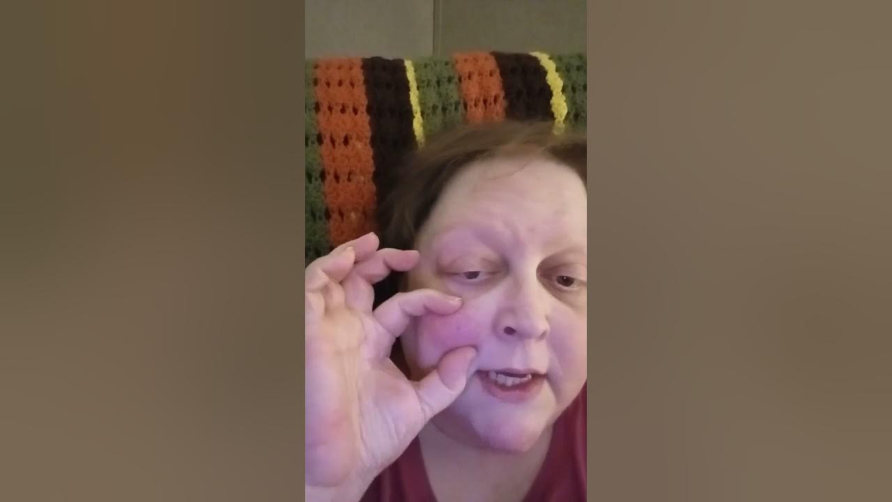 why-won-t-this-knot-on-my-face-go-away-after-my-fall-youtube