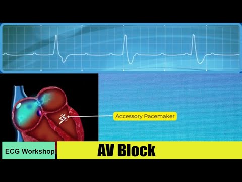 AV Block: ECG features and Comparison with ECG simulator